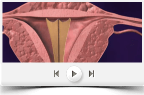 Novasure Endometrial ablation operations